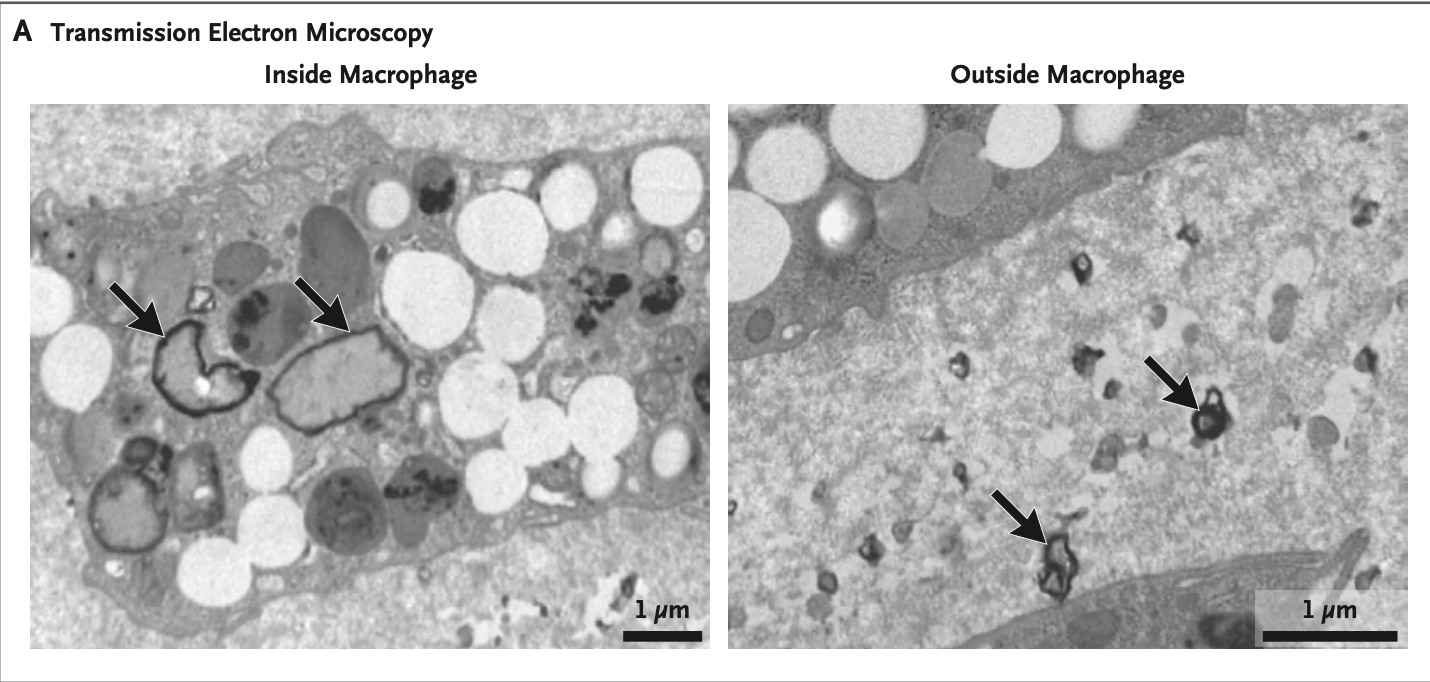 Microscope showing plastics in arterial plaque